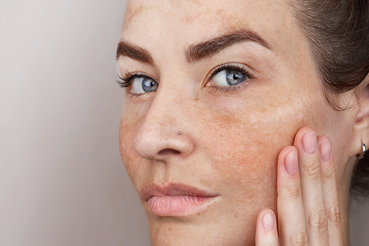 Pigmentation image 1