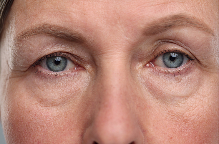 Sagging eyelids - what can help them image 1