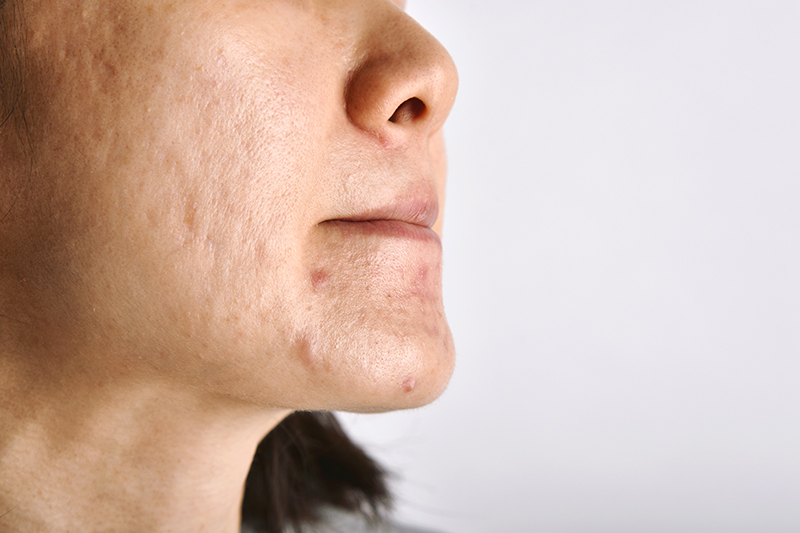 Acne scars image 2