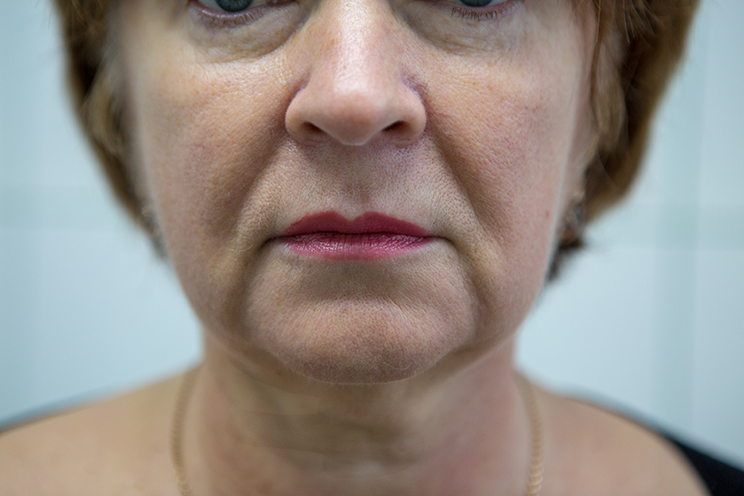 Facial skin sagging image 2