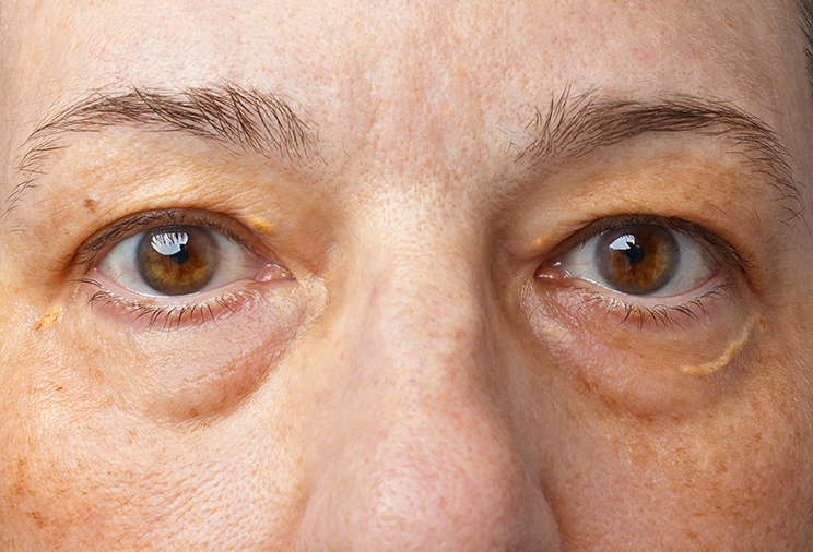 Sagging eyelids - what can help them image 2