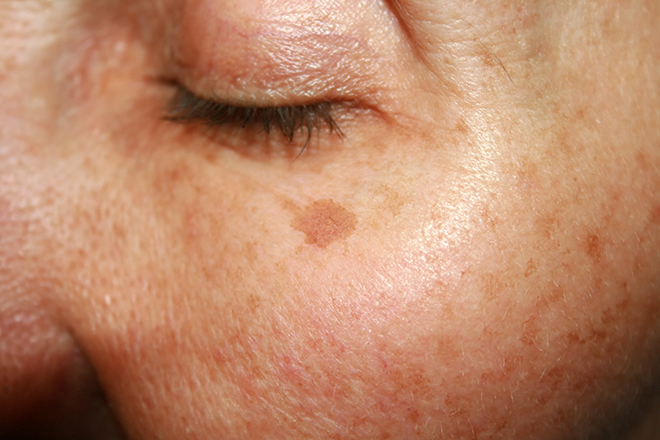 Sun damage and wrinkles image 2