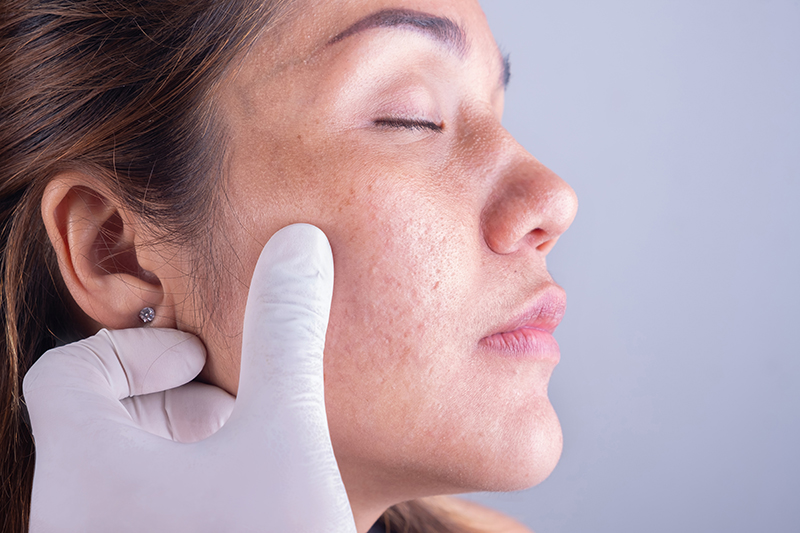 Acne scars image 3