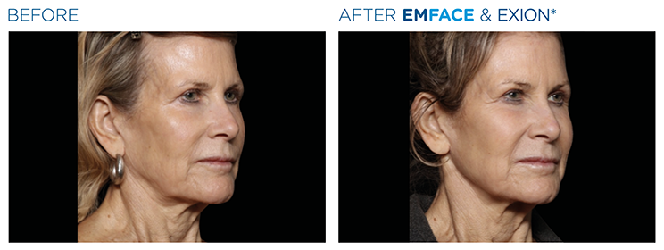 Facial skin sagging image 4