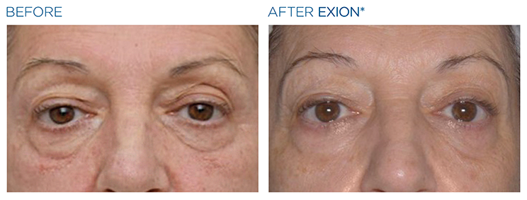 Sagging eyelids - what can help them image 4