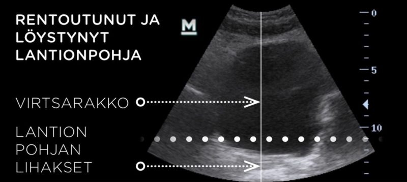 emsella ultraäänitutkimus 1