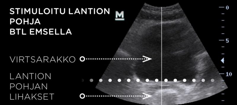 emsella ultraäänitutkimus 2