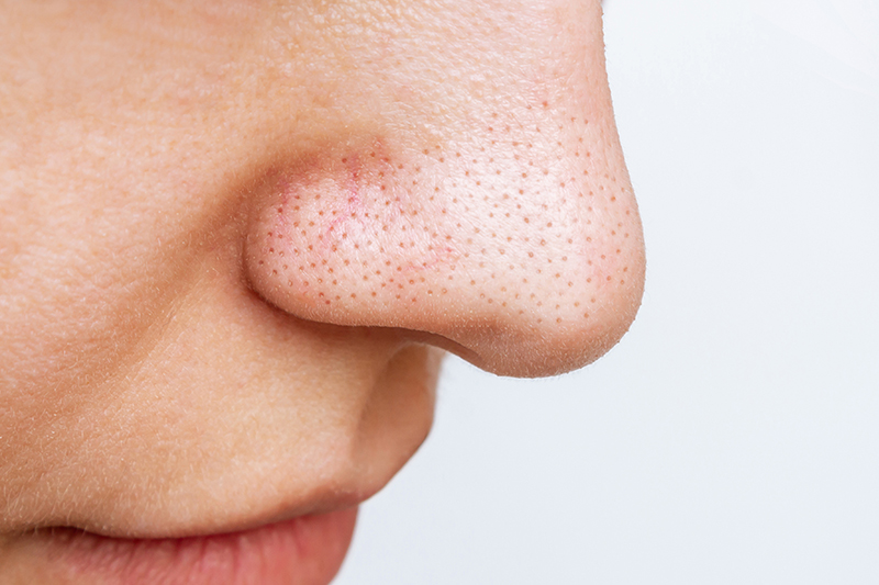 Close-up of a nose with visible blackheads and enlarged pores – focus on blackhead removal.