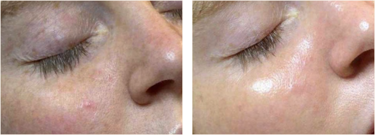 hydrafacial example 1