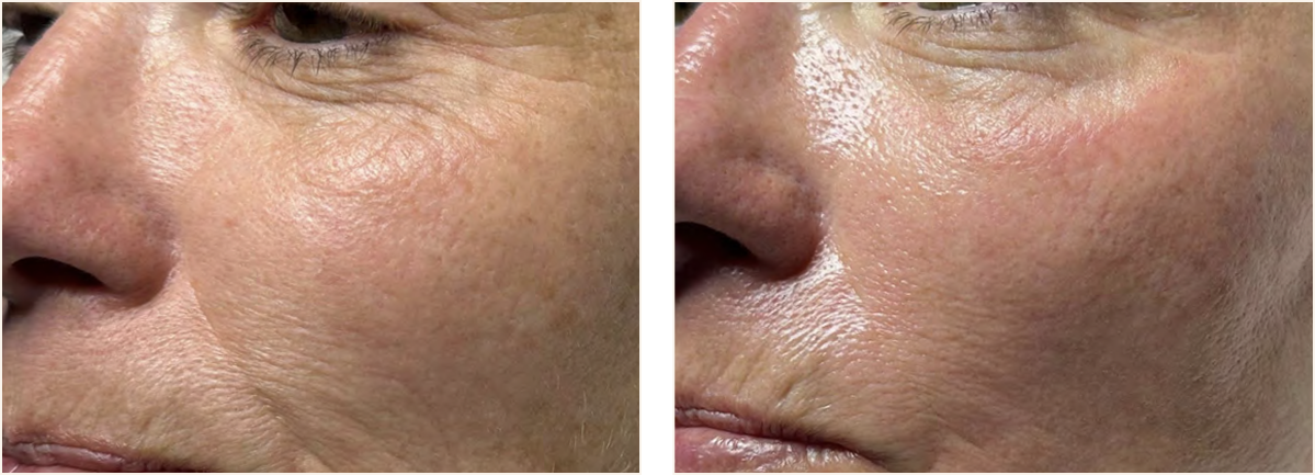 hydrafacial example 2