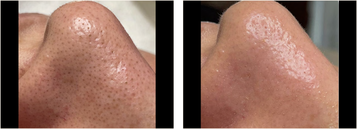 hydrafacial example 3