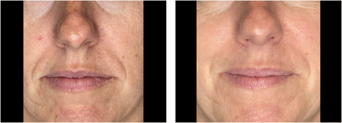 hydrafacial example 4