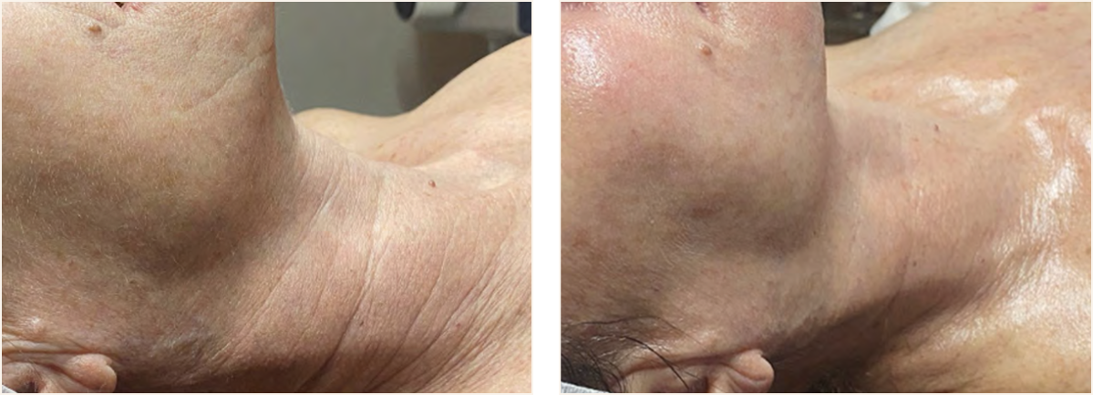 hydrafacial example 4