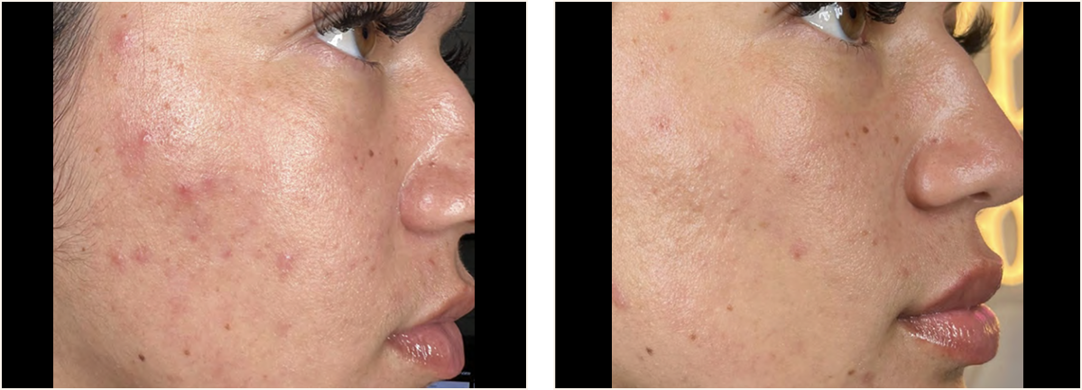 hydrafacial example 4