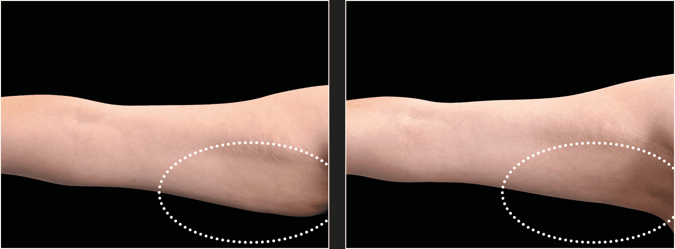 emsculpt kadet example 4