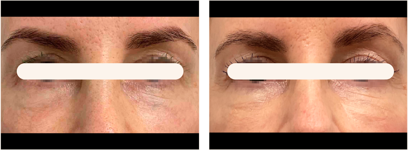 emface kulmakarvat example 3