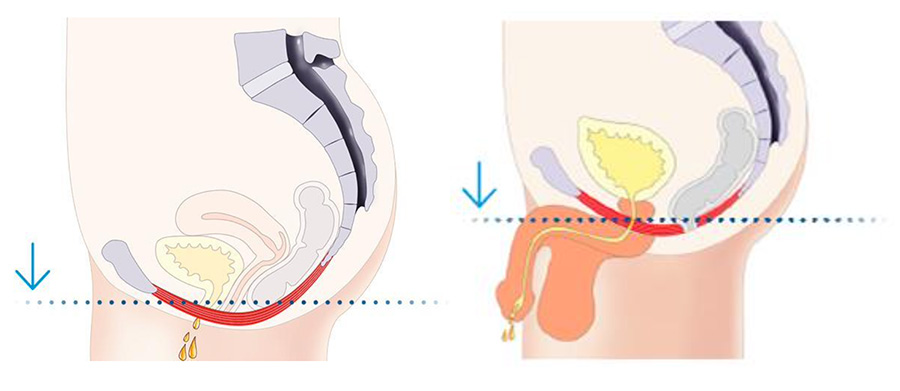 urinary incontinence image