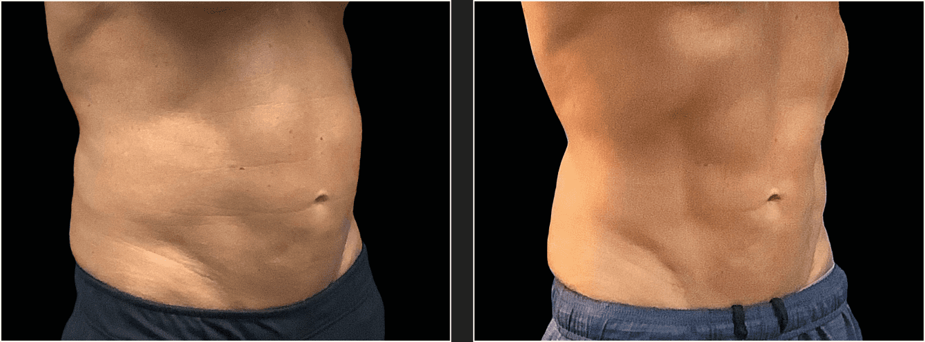 emsculpt vatsa example 20