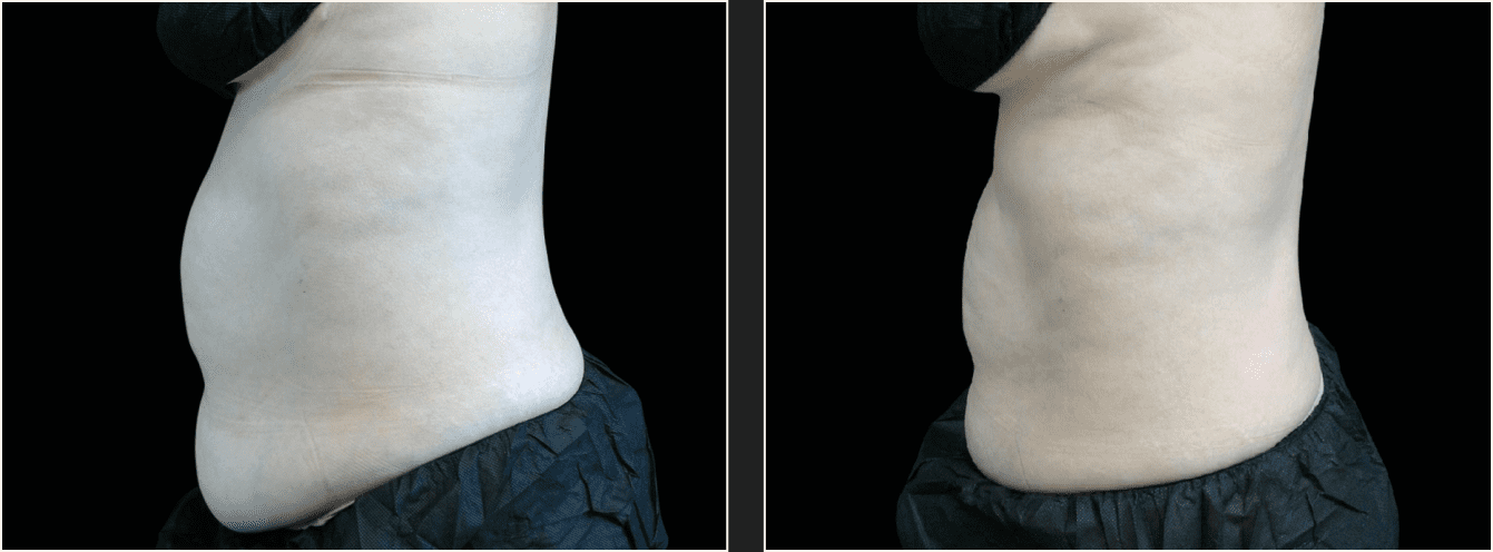 emsculpt vatsa example 21