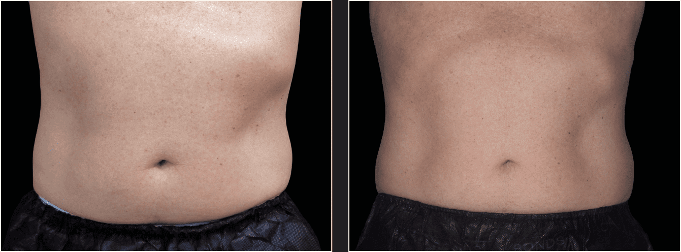 emsculpt vatsa example 24