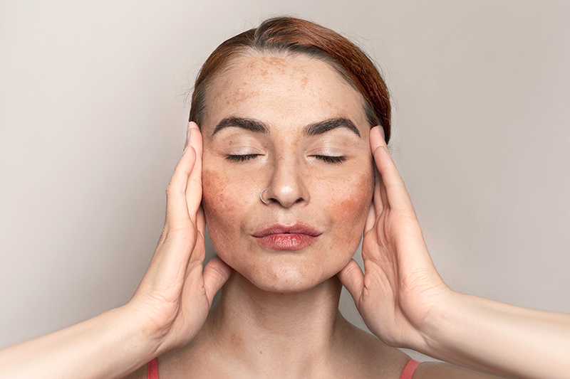 Naisen kasvot lähikuvassa, kuvassa näkyy pigmenttiläiskä kasvoissa, maksaläiskät ja pigmentaatio.